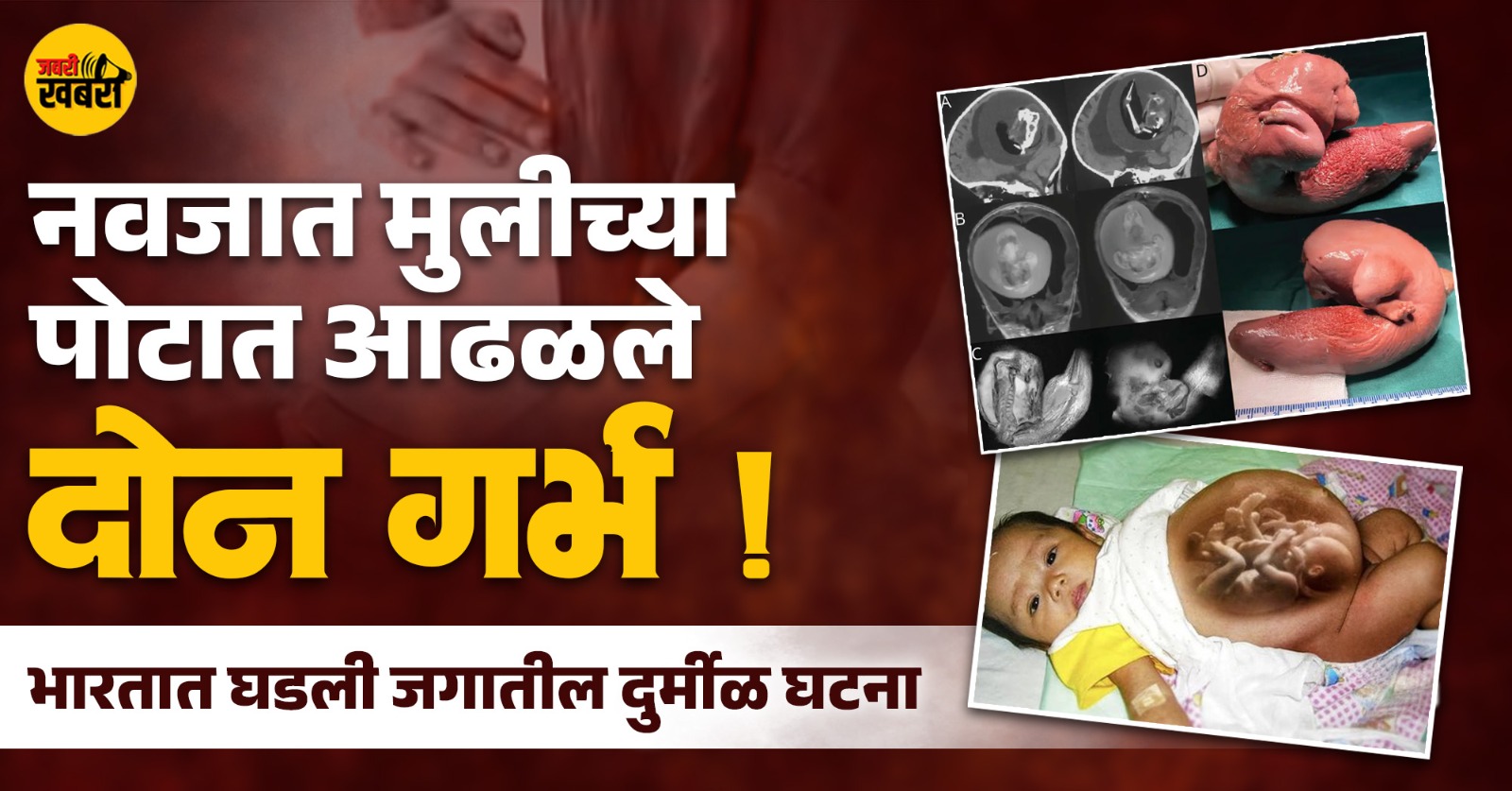 नवजात मुलीच्या पोटात आढळले दोन गर्भ!